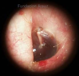 Otitis media exudativa.jpg