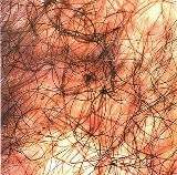 Pediculosis Púbica..jpg