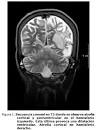 Anemia carebral.jpeg