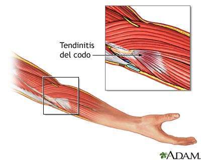 Archivo:Tendinitis del codo 19632.jpg