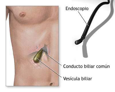 Archivo:Biopsia del tracto biliar.jpg