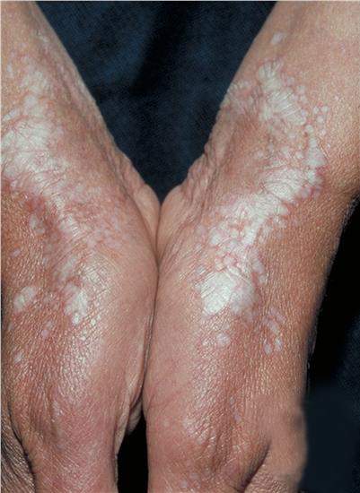 Archivo:Manos con liquen escleroso .jpg