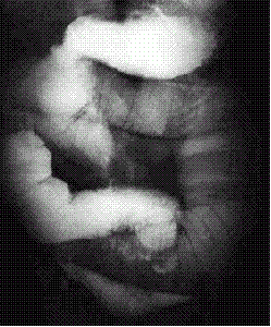 Enteritis por radiación.gif