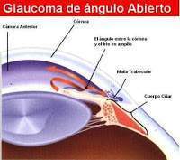 Glaucoma2.jpg