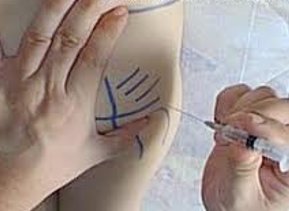 Tecnica de inyeccion.jpg