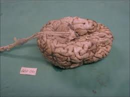 Atrofia olivopontocerebelosa2.jpeg