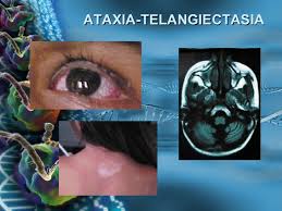 Telangiectasia.jpg