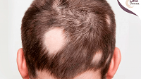 Alopecia.png