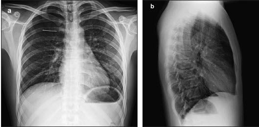 Archivo:Tramautsmo toraxco.jpg