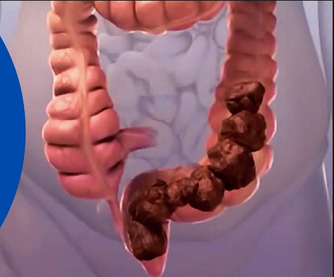 Archivo:Fecaloma 1.png