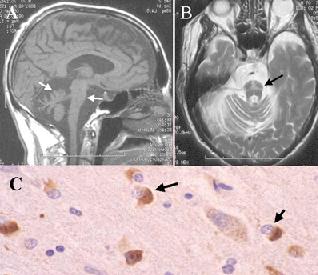 Síndrome de ShyDrager EcuRed