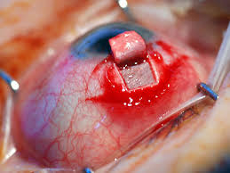 Cirugia del glaucoma.jpg