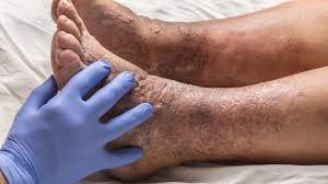 Isquemia de extremidades inferiores.jpg