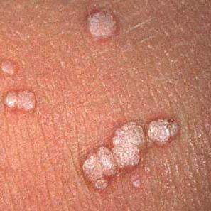 Verrugas genitales de forma natural 287 orig.jpg