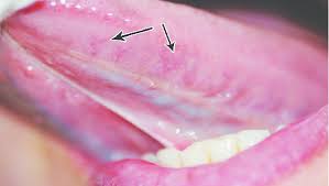 Linguales varices.jpg