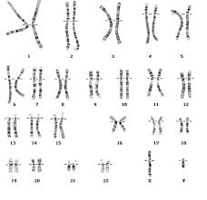 Sindrome disgenesia.jpg