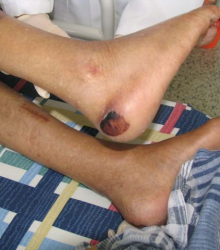 Escaras de la piel.png