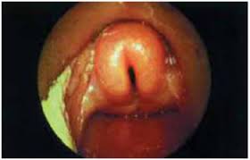 Sarcoidosis laríngea.jpg