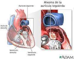 Aurícula izquierdaaa.jpg