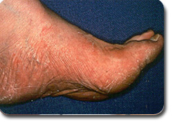 Ejemplo de Epidermofitosis.JPG