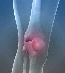 Lesiones-de-partes-blandas-de-la-rodilla.jpg