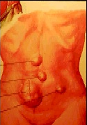 Hernia abdominal.png