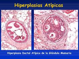 Hiperplasia ductal atípica de la Glándula Mamaria.jpg