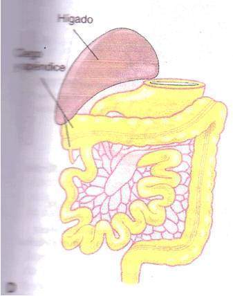 Archivo:Internal hernia.jpg