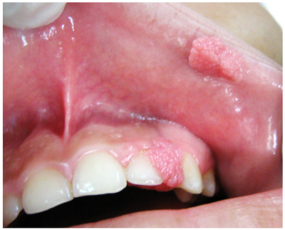 papiloma virus bucal tratamiento
