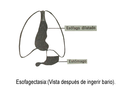 Archivo:Esofagectasia.jpg