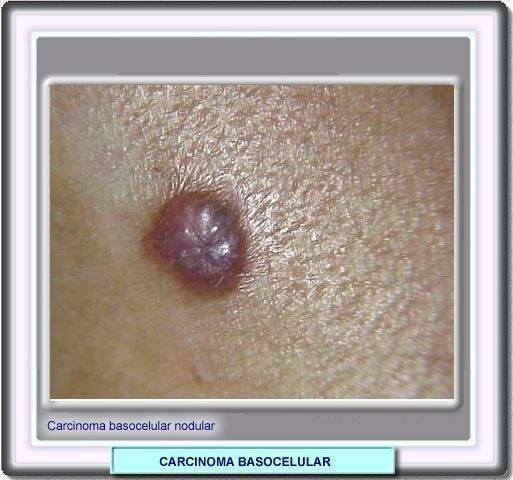 Archivo:Carcinoma basocelular.jpg
