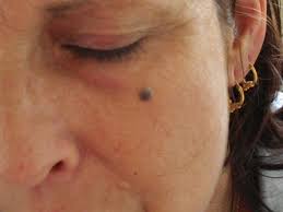 Nevus1.jpeg