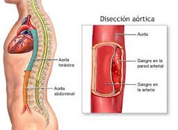 Aneurisma aórtico01.jpeg