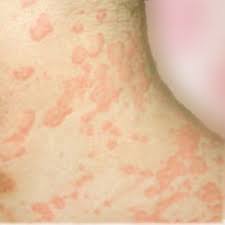 Prurito Acuajenico.jpg