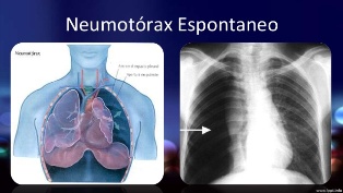 Neumotrax-espontneo-6-638.jpg