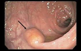 Tumores gastroenteropancreaticos.jpg