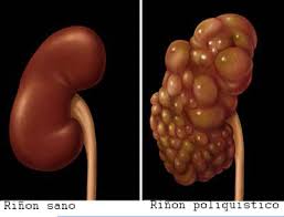 Riñon esponjoso.jpeg