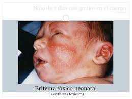 Eritoxinenatal.jpg