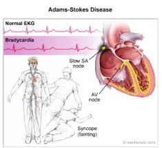 Síndrome de Stokes-Adams.jpg