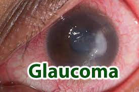 CLAUCOMA peligrosa.jpg