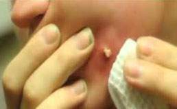 Lesión furuncular de 2 a 3 cm