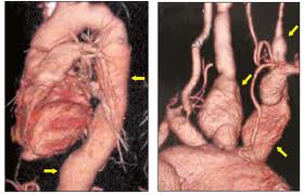 Arteritis de Takayasu2.jpeg