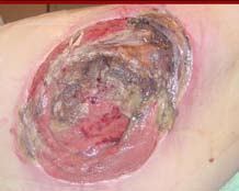 Ulcera cutanea grado4.png