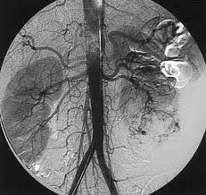 Resultado de imagen de arteriografÃ­a