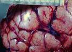 Embolia cerebral jcmzlloIV.jpg