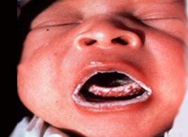 Archivo:Candidiasis-bebe.jpg