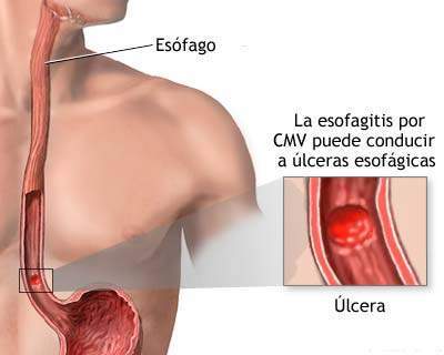 Archivo:Esofagitis por CMV.jpg
