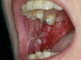 Pénfigo laríngeo.jpg