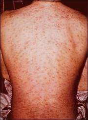 Alergias farmacológicas.jpg