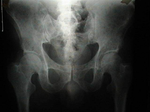 Mieloma múltiple - EcuRed